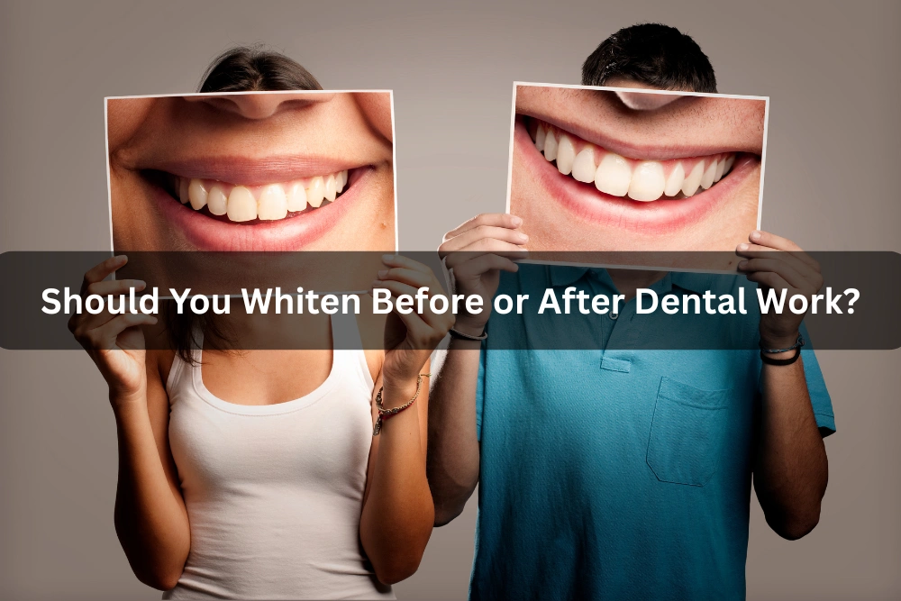Should You Whiten Before or After Dental Work?